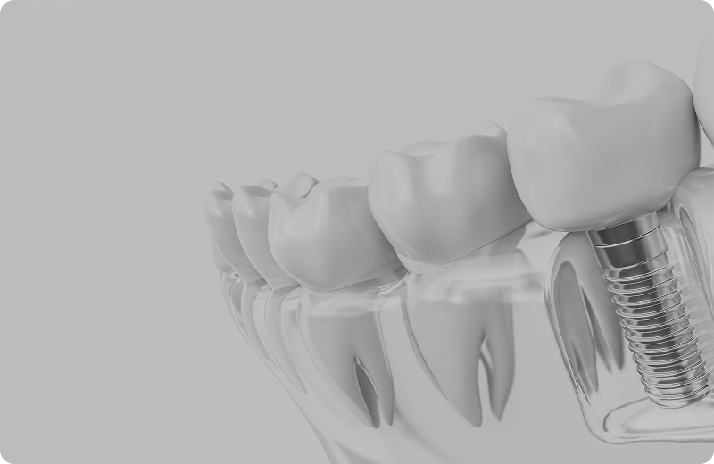 インプラント