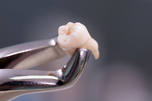 最短1分・即時抜歯可能