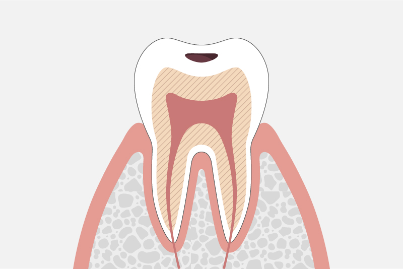 C1：エナメル質内の虫歯