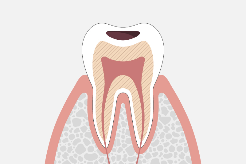 C2：象牙質に達した虫歯