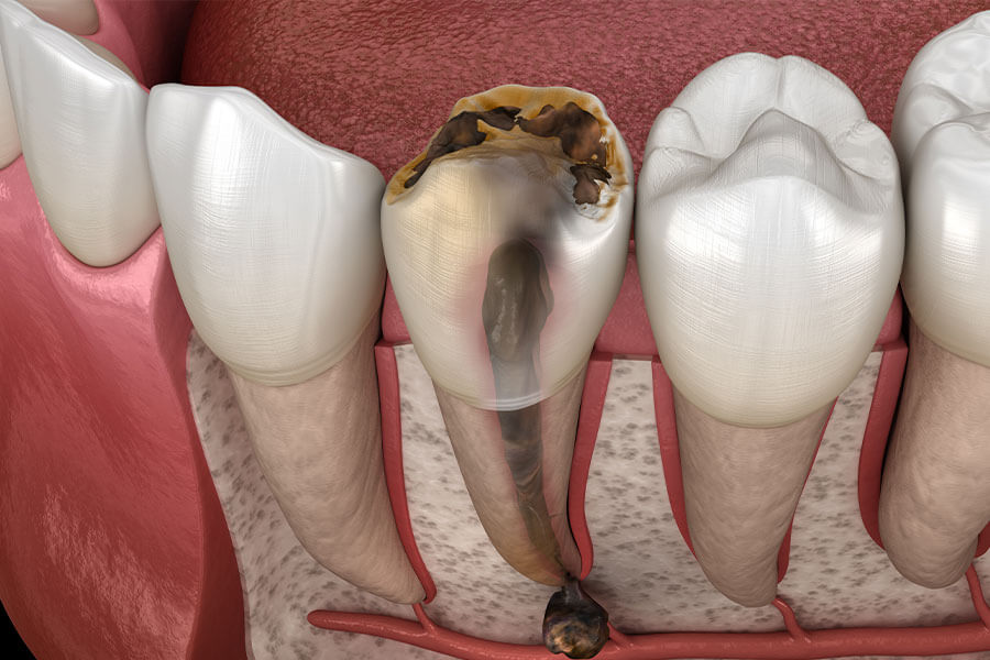 歯の根っこに膿が溜まってしまっている歯